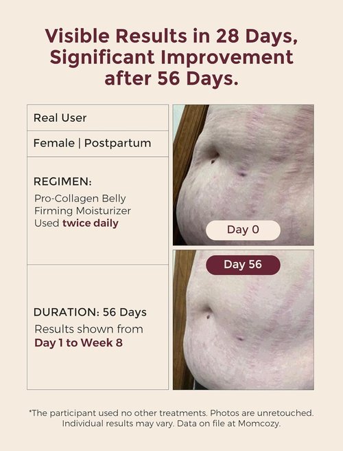 Momcozy Stretch Mark Cream - Pro-Collagen Belly Firming Moisturizer with Facial-Grade Peptides | 5.29 oz (150g)